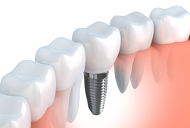 Dental Implants