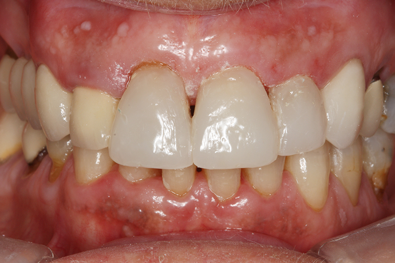 Composite Fillings1 After