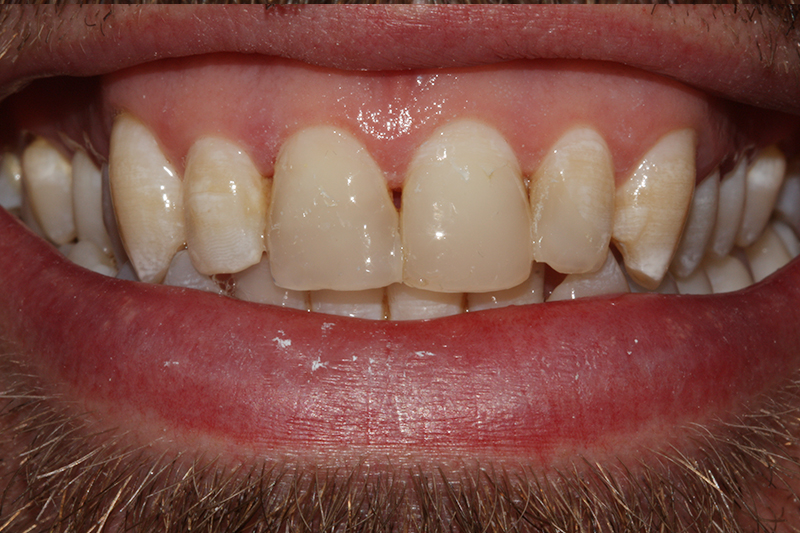 Composite Fillings2 After