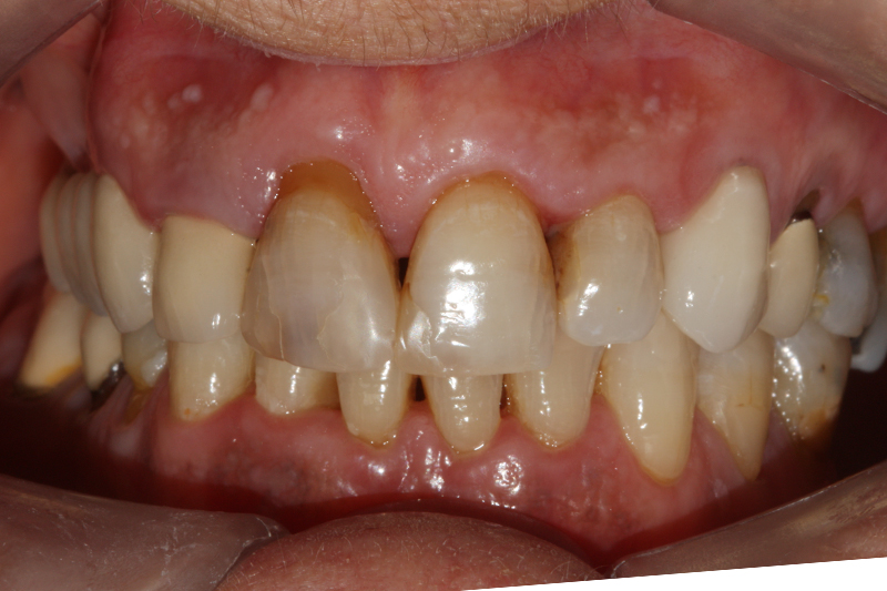 Composite Fillings1 Before