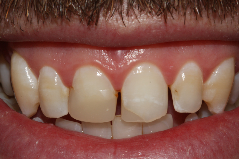 Composite Fillings2 Before