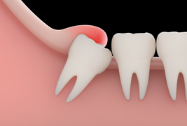 Tooth Extraction