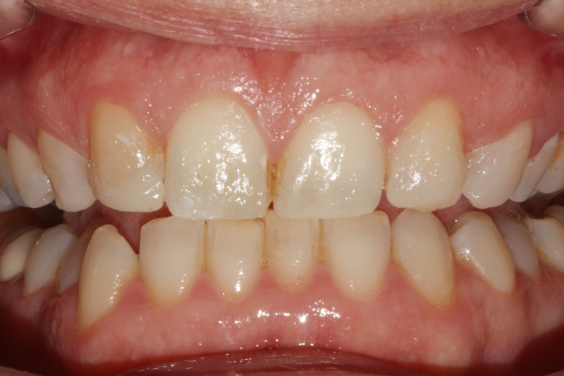 Composite Veneer 1 After