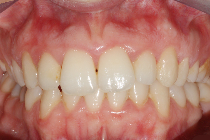 Inman Aligner1 After