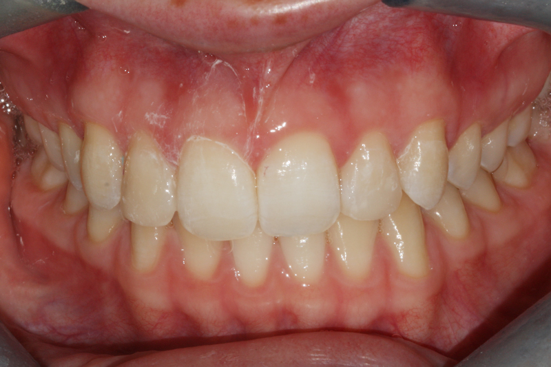 Porcelain Veneers1 After