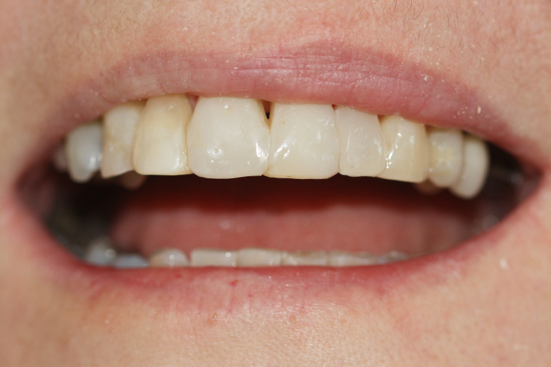 Composite Veneer 2 After