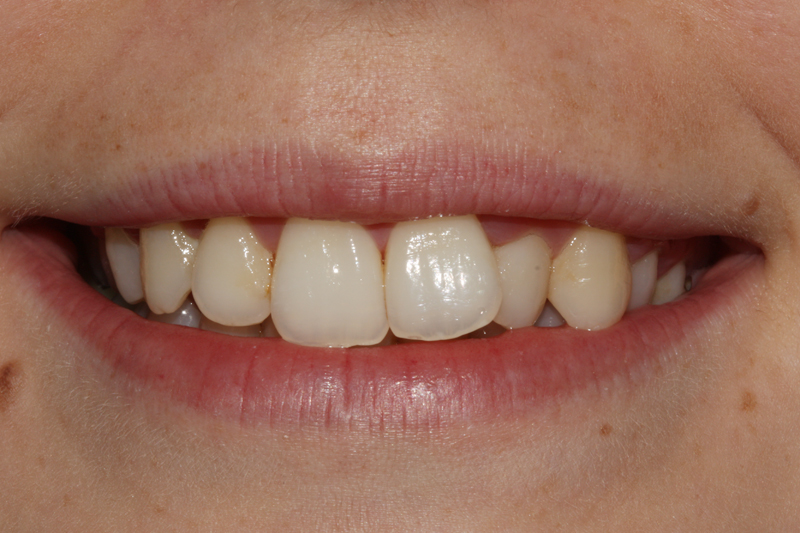 Inman Aligner1 Before