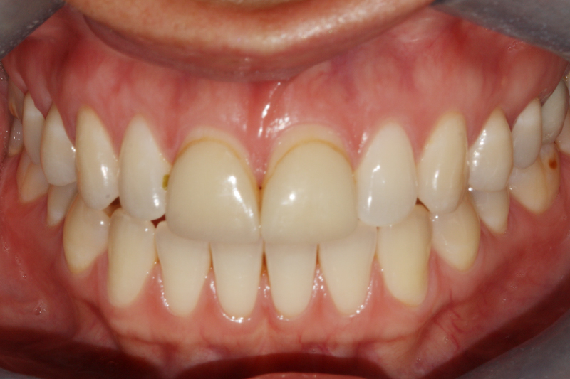 Porcelain Veneers1 Before