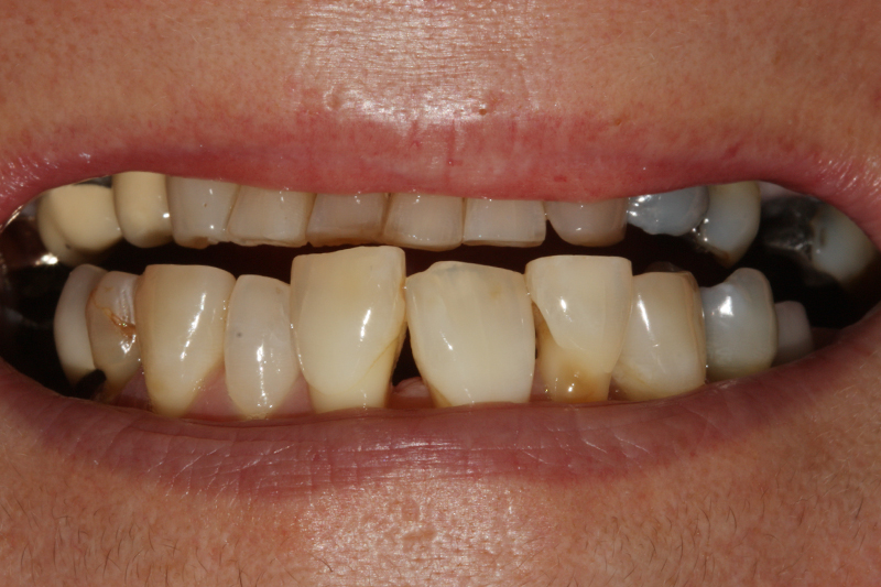 Composite Veneer 2 Before